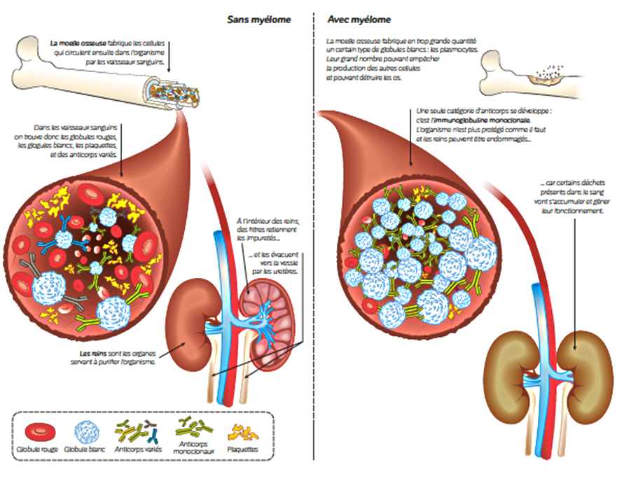 Le myélome multiple : une maladie de la moelle osseuse